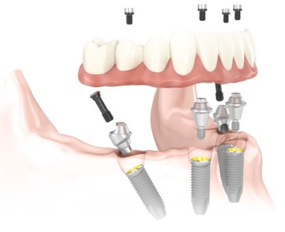 all-on-4 implant supported denture