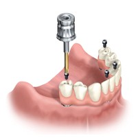 placement of All-on-four denture